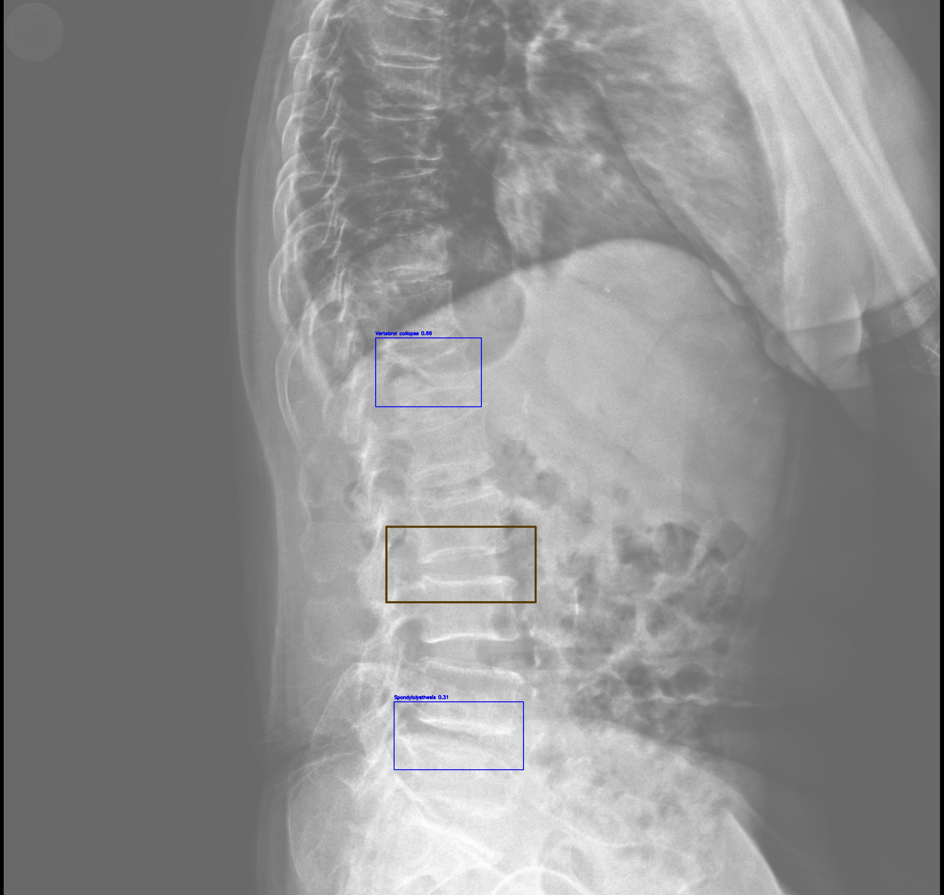 Spondylolisthesis